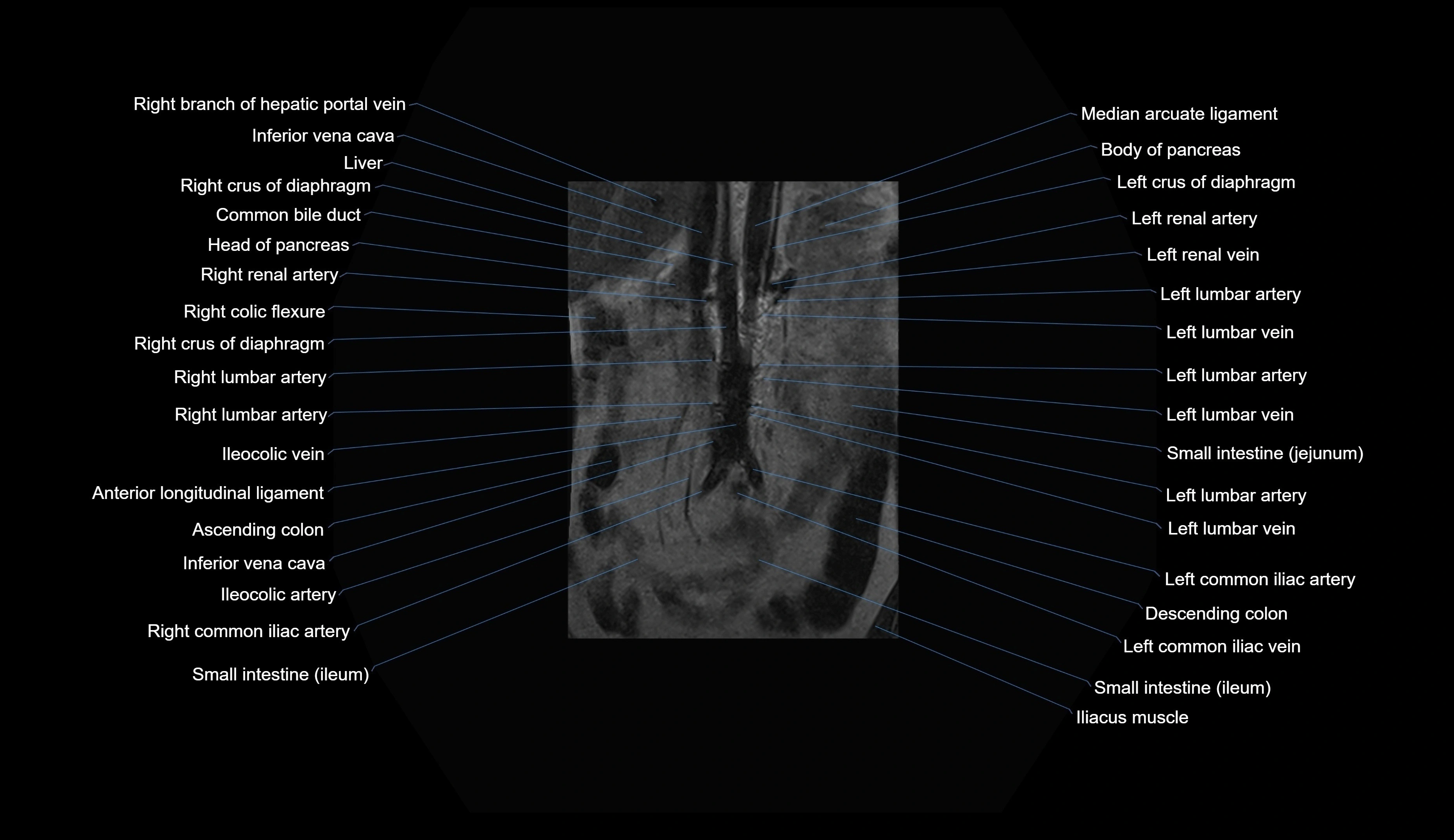 MRI lumbar spine coronal cross sectional anatomy 3T radiology  image-img-00001-00003.webp